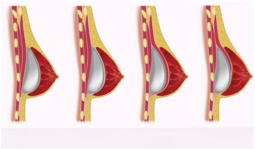 access for implant installation